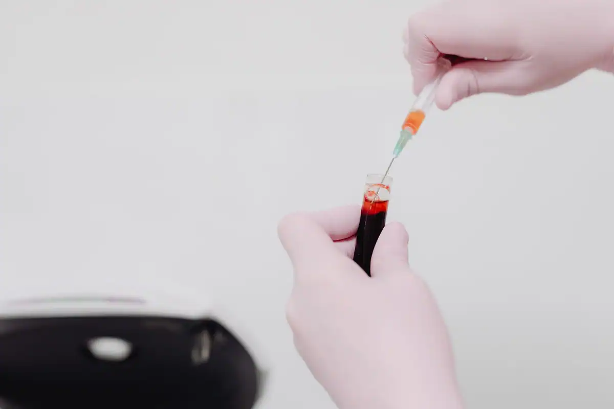 Laborant care manipulează cu seringa o probă de sânge pentru analiza colesterolului